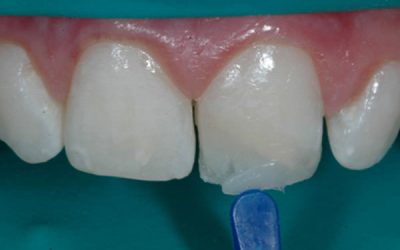 Estratificación con resinas compuestas en el sector anterior