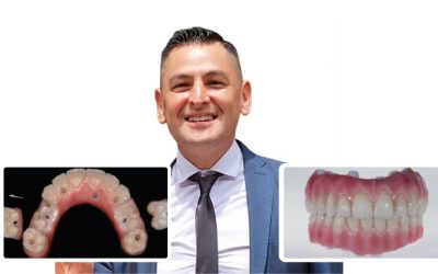 Prótesis híbridas sobre implantes. De lo simple a lo complejo