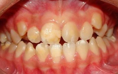 Curso online: Hipomineralización molar incisiva (HMI). Del diagnóstico al tratamiento