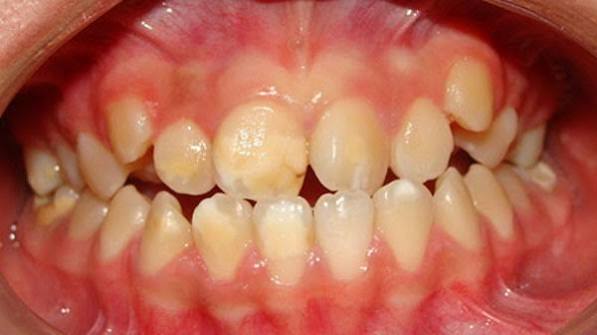 Curso online: Hipomineralización molar incisiva (HMI). Del diagnóstico al tratamiento